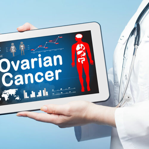 Ovarian cancer &#8211; Early signs and foods that help prevent it