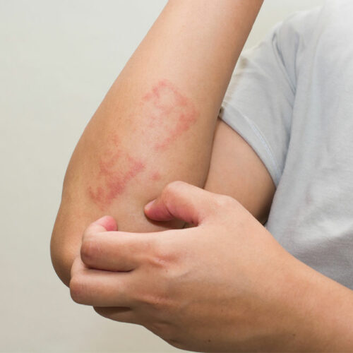 Effective home remedies to manage eczema