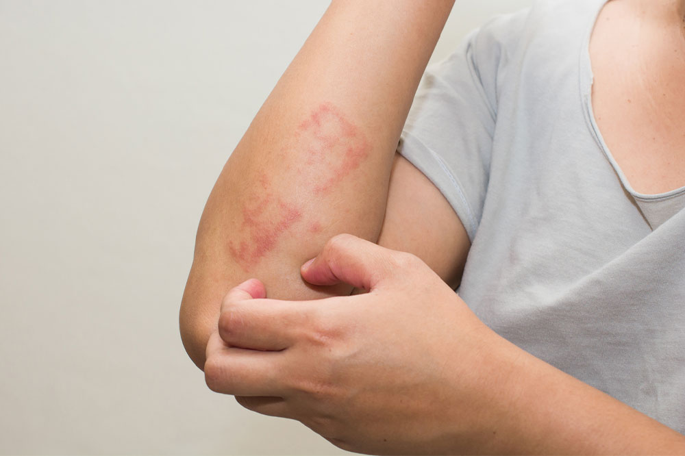 Effective home remedies to manage eczema