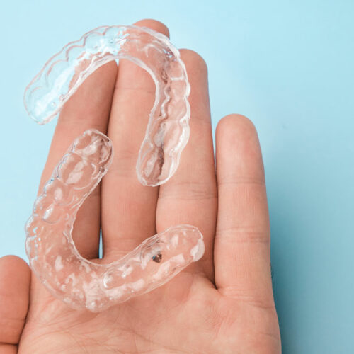 Four reasons to prefer clear aligners over braces