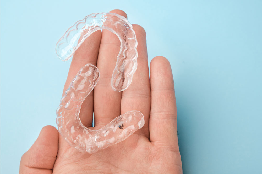 Four reasons to prefer clear aligners over braces