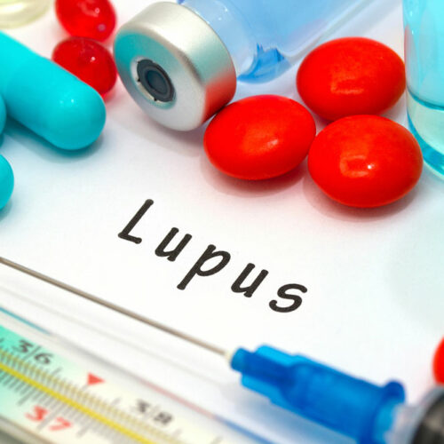 Lupus &#8211; Signs, home remedies, and management