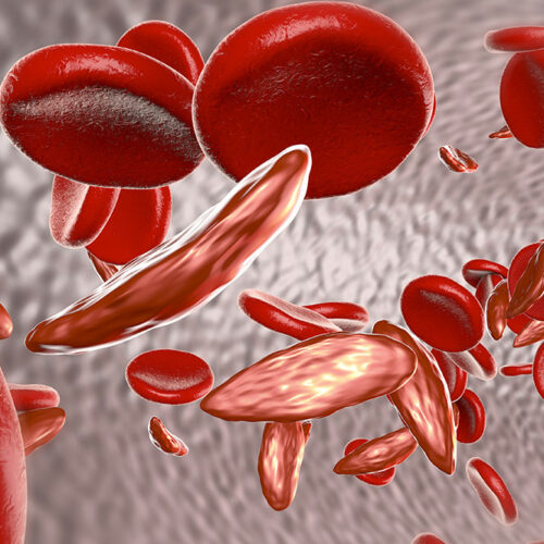 Sickle cell anemia: Symptoms, causes, and treatment