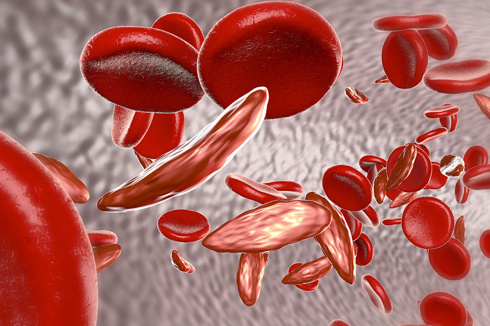 Sickle cell anemia: Symptoms, causes, and treatment