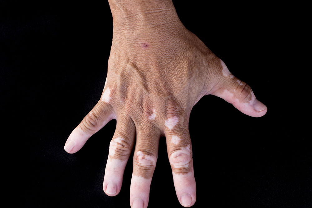 3 ways to stop vitiligo from spreading