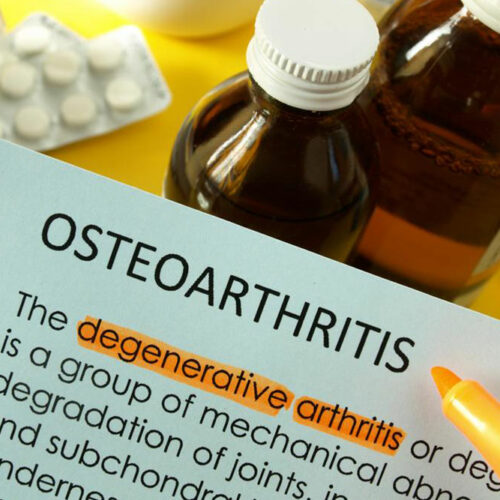 Osteoarthritis &#8211; How to Treat it