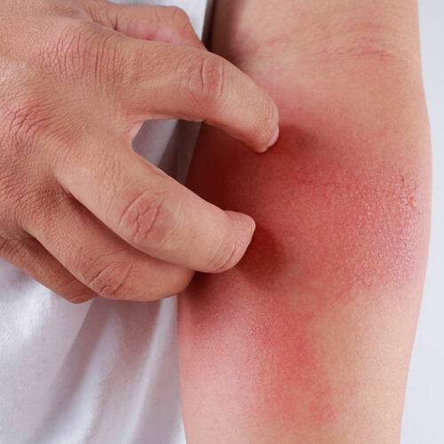 All You Need to Know about Eczema