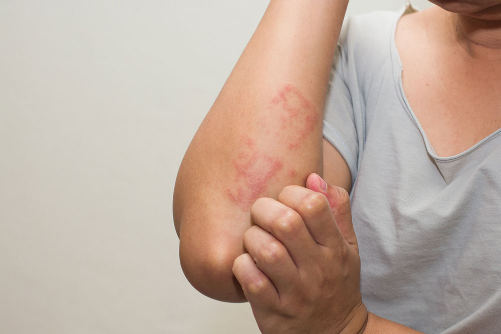 Common Types and Treatments of Eczematous Dermatitis