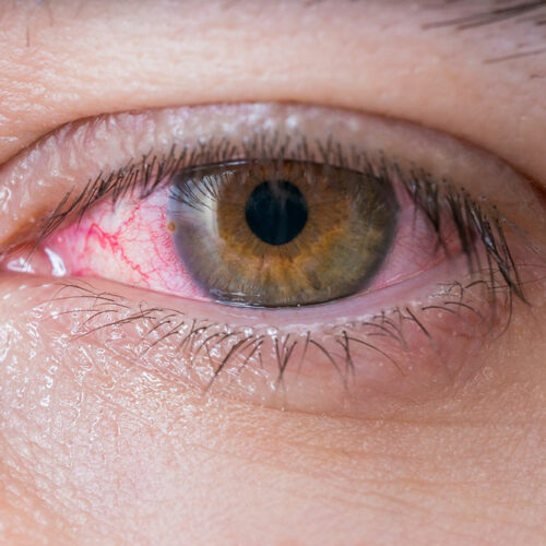 Red Eyes &#8211; Common Symptoms, Causes, and Treatment