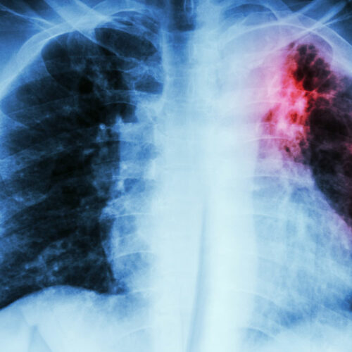 Symptoms and Diagnosis of a Pulmonary Embolism